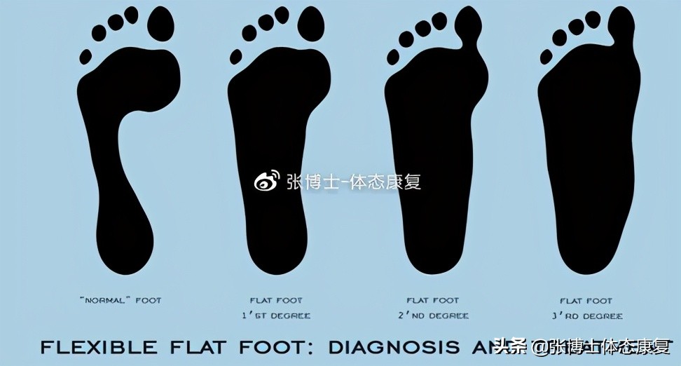 扁平足矫正的最佳年龄怎么矫正,扁平足的矫正方法舞蹈