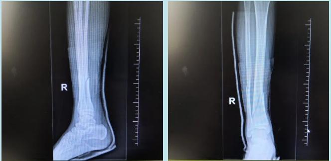「医生告诉你」初三学子一开学就骨折！刚返校切勿“报复性运动”