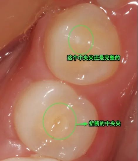 男童牙齿长在牙龈上,男童牙齿内壁长了一颗牙