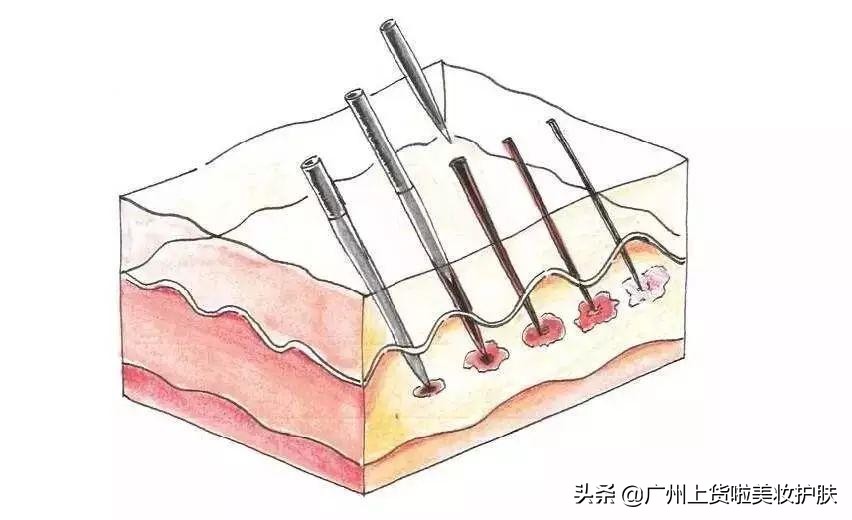 现在流行的美容打什么针,美容上的微针是怎么回事