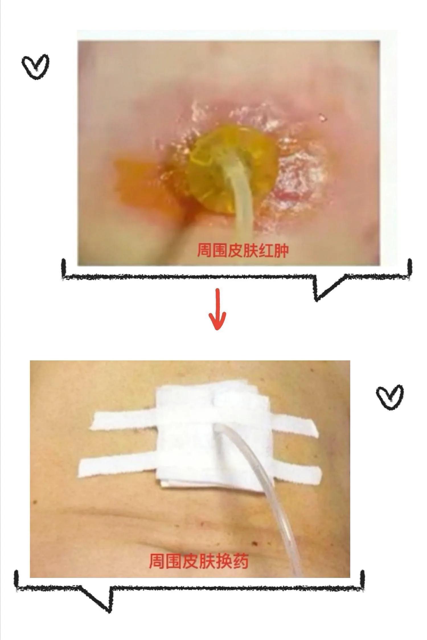 胃造瘘术后的护理方法图片,胃造瘘日常护理视频