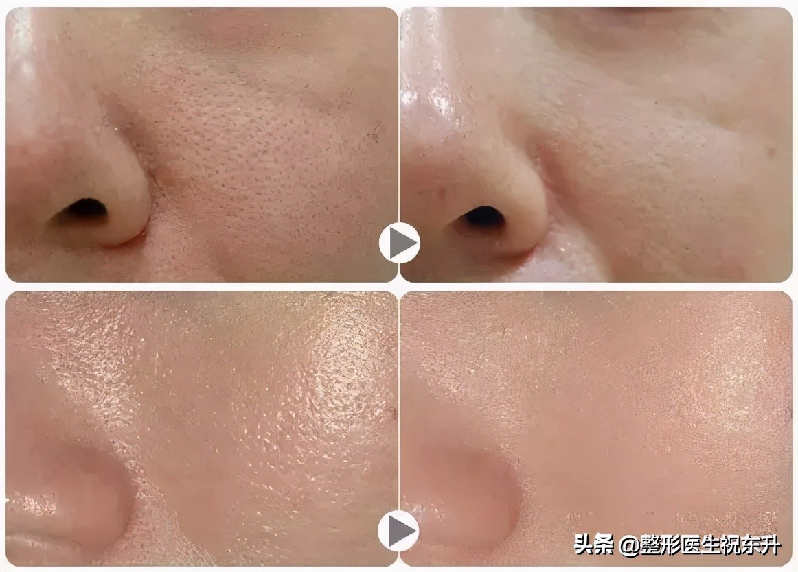 没做过“水光针”的人，听我谈谈真实的感受