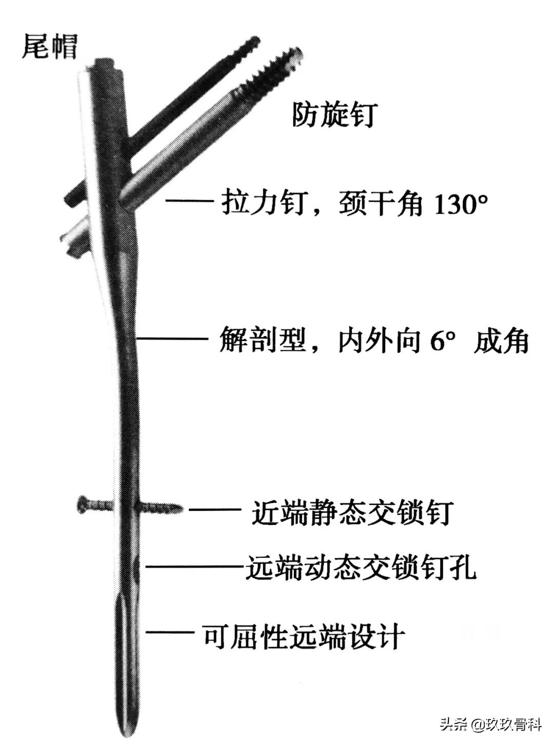 骨科用髓内钉什么材料,骨科髓内钉的作用