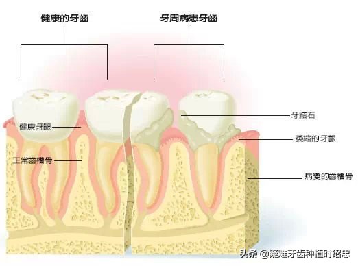 牙缝大是福是祸,牙缝宽什么命运