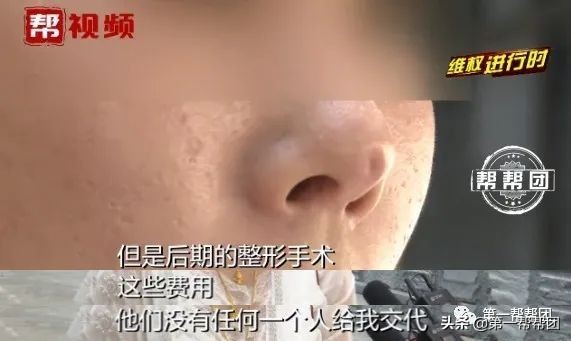 做了隆鼻几年了突然流脓,隆鼻一个月鼻孔里面伤口有脓点