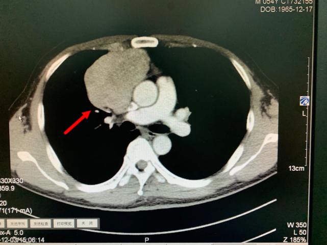 胸腔里长了个九厘米瘤子怎么回事,胸腔食管外面长个拳头大小瘤