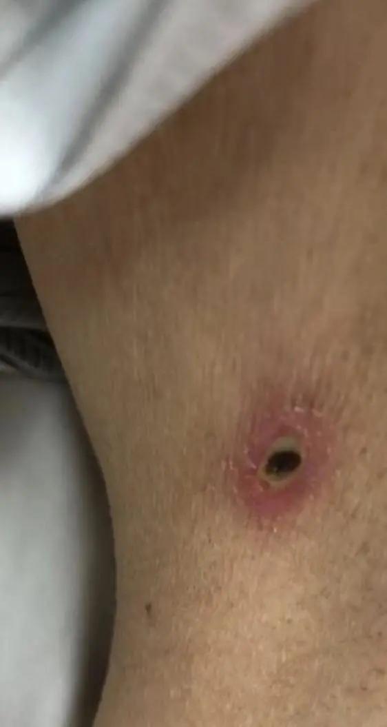 成人女性身上很多褐色小斑点,身上出现结痂一样的小黑点