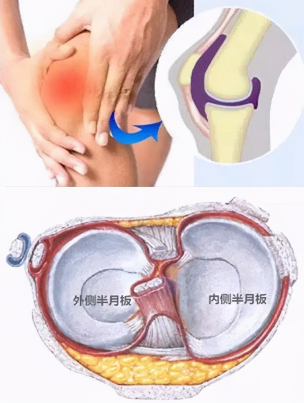膝盖总是疼半月板损伤怎么治,膝盖一直痛是什么病