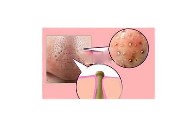 鼻子上挤出来的白色水是什么,鼻子上的油脂挤出后留下的东西