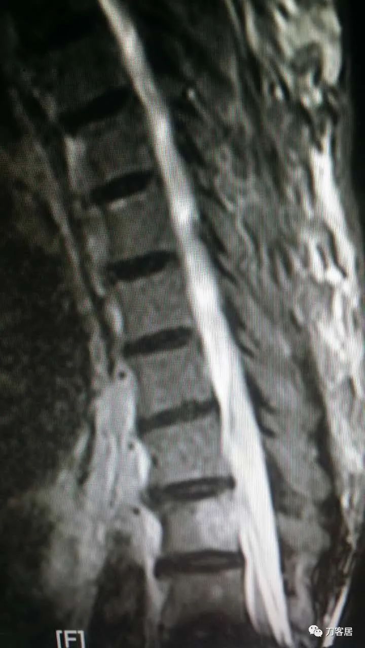 腰椎手术切掉棘突,腰突微创后出血肿