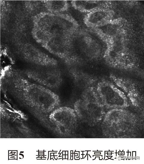 炎症性皮肤病反射式共聚焦显微镜诊断特征专家共识全文发布
