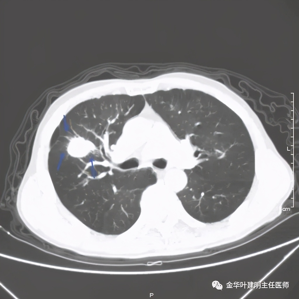 左肺占位被安排穿刺活检是肺癌吗,肺癌肺部穿刺有什么危险