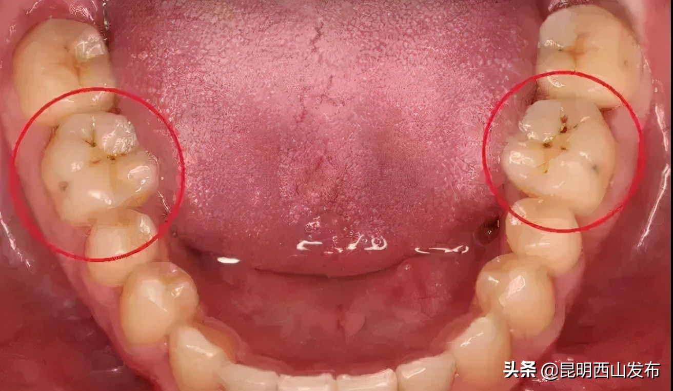 牙齿上有黑点可怕吗,牙齿上有小黑点原来这么可怕
