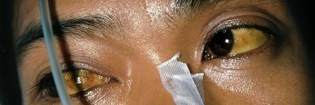 肝脏变黑的三个地方图,肝变硬前预兆