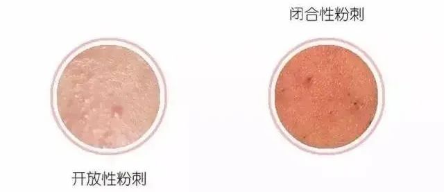 挤不出来的粉刺是什么,挤不出来的闭口自己能消失么