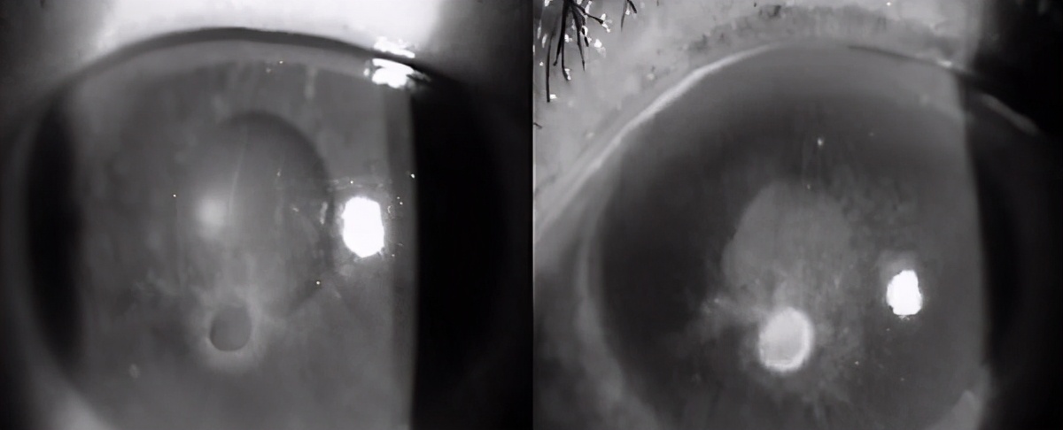 儿童角膜溃疡严重会穿孔吗,儿童角膜溃疡