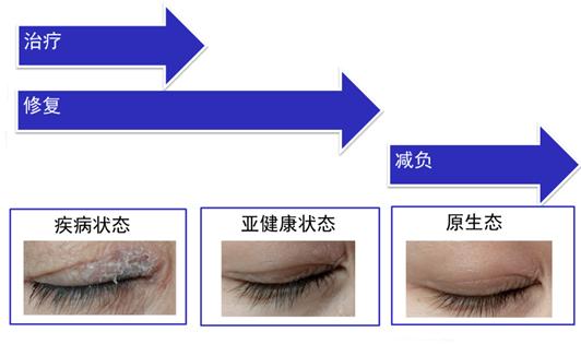 皮炎湿疹好了以后皮肤发红,湿疹反复发作能否转为皮炎