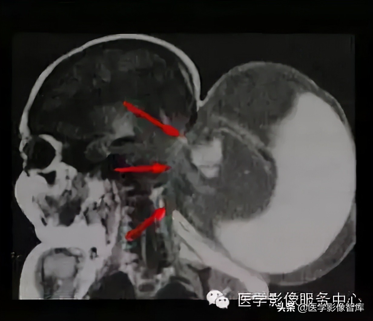 chiari畸形确诊,chiari畸形症状会一直有吗