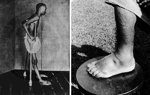 没有传染源为什么得脚气,没有真菌感染为什么得脚气