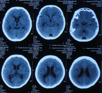 结核性脑积水,脑膜炎脑积水要治疗多久