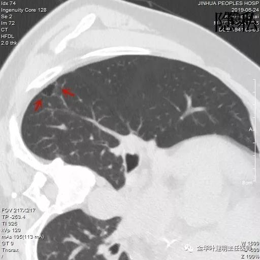警惕-会是简单的肺大泡吗？