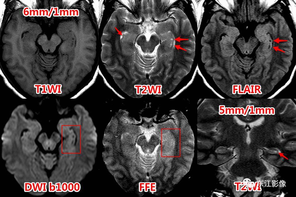 头颅mri扫描影像哪里找,头颅影像mra详细解说