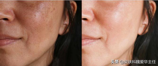 大面积褐青斑怎么治,有什么好方法淡黄褐斑