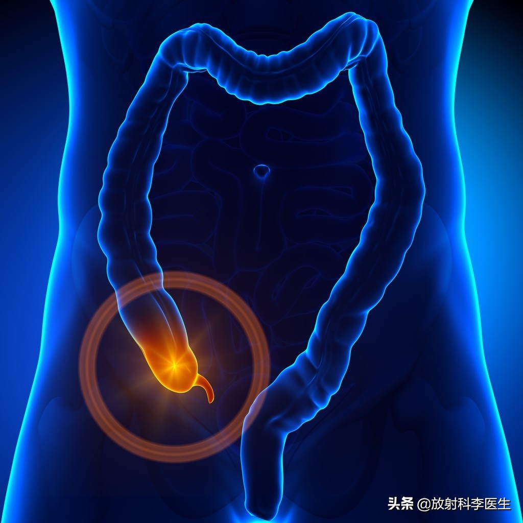 患者典型阑尾炎表现,为什么CT检查后李医生诊断为憩室炎?