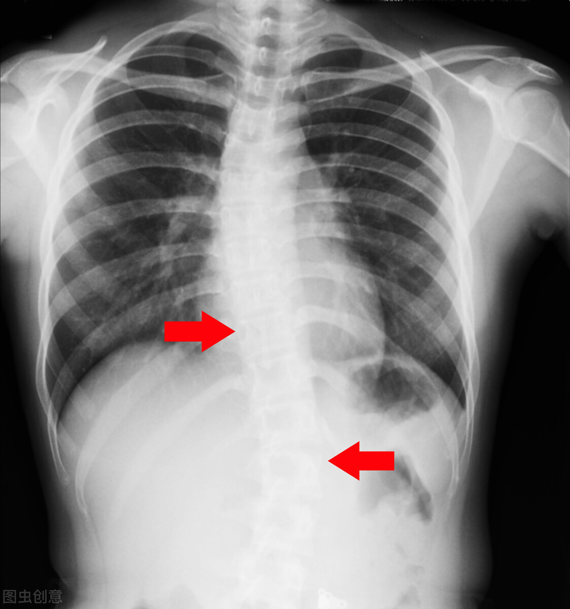 成人脊柱侧弯压迫肺部怎样缓解,成人脊柱侧弯引起腰疼怎么缓解