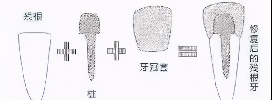 根管治疗后牙裂了还可以做牙冠吗,根管治疗后戴牙冠有什么利弊