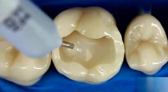 蛀牙在疼痛时期可以治疗吗,蛀牙早期不疼的时候怎么治疗