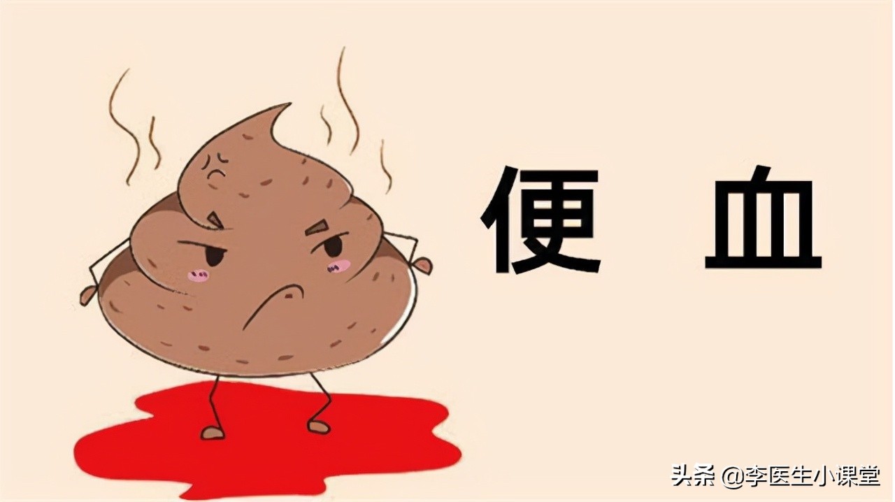 82岁老人便血半年检查肠癌,八十岁老人得肠癌总便血怎么办