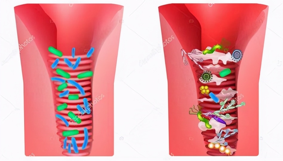 妇科疾病导致卵巢癌,卵巢炎会引起卵巢癌吗