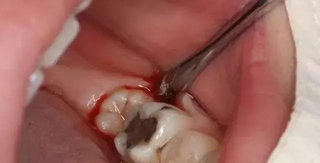 拔牙打麻药是用针扎还是抹上去,拔牙打麻药对脑神经有影响吗