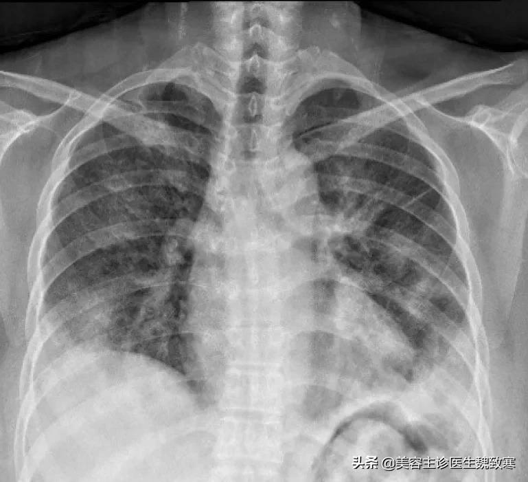 私密整形术后一直出血,私密整形引发肺栓塞