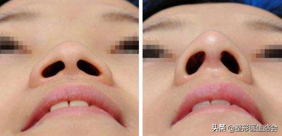 鼻翼缩小鼻骨内推手术,宽鼻头缩窄手术好做吗