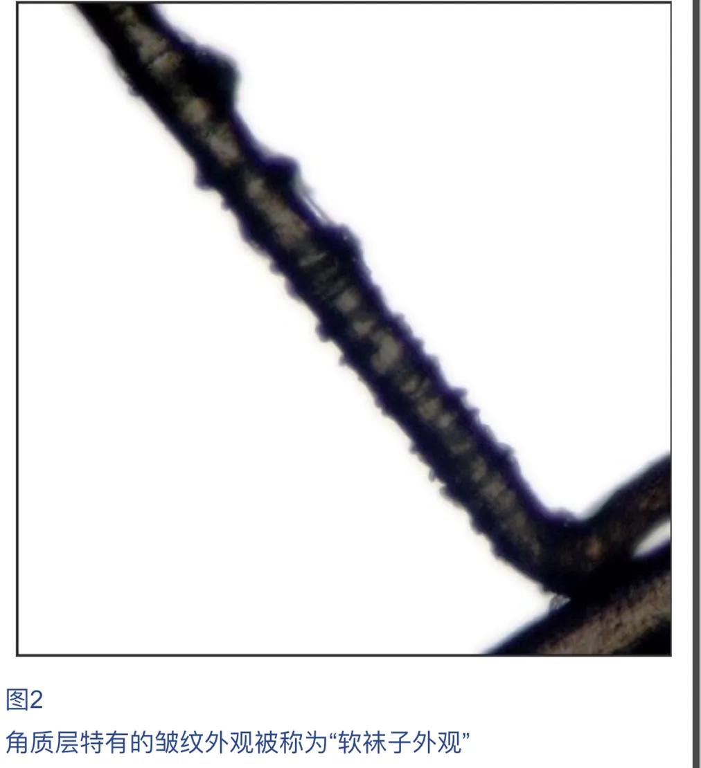 儿童脱发会是什么病的前兆,孩子毛囊引起的脱发怎么办