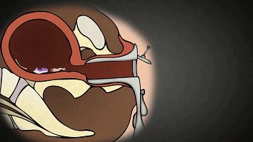 堕胎可怕吗,堕胎到底多可怕