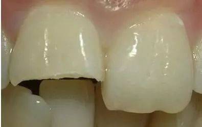 牙齿受外力缺损还能补吗,意外把牙摔坏了