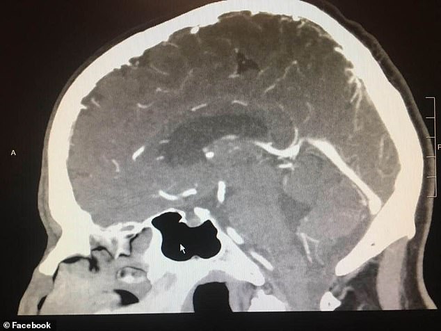 美国男子治疗癌症晚期,26岁男孩身患恶性脑瘤