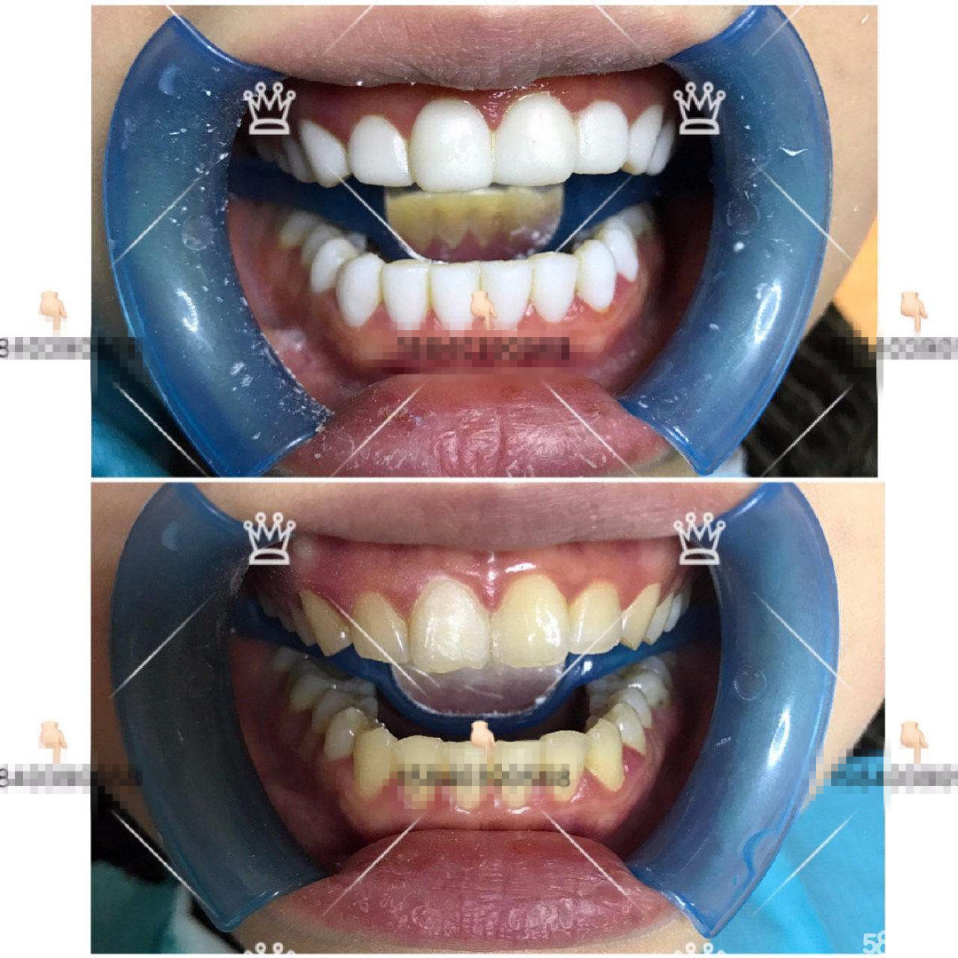 树脂贴面和烤瓷贴区别,贴面树脂的好还是烤瓷的好