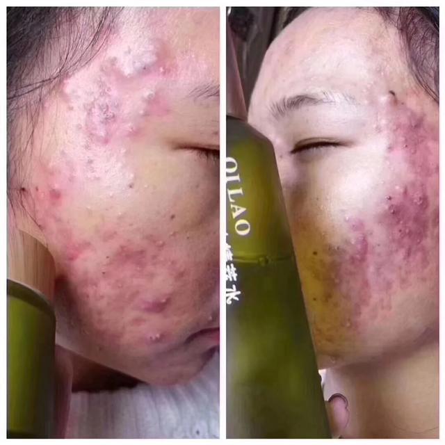 七老真的能修复激素脸吗,七老真的能修复好激素脸吗