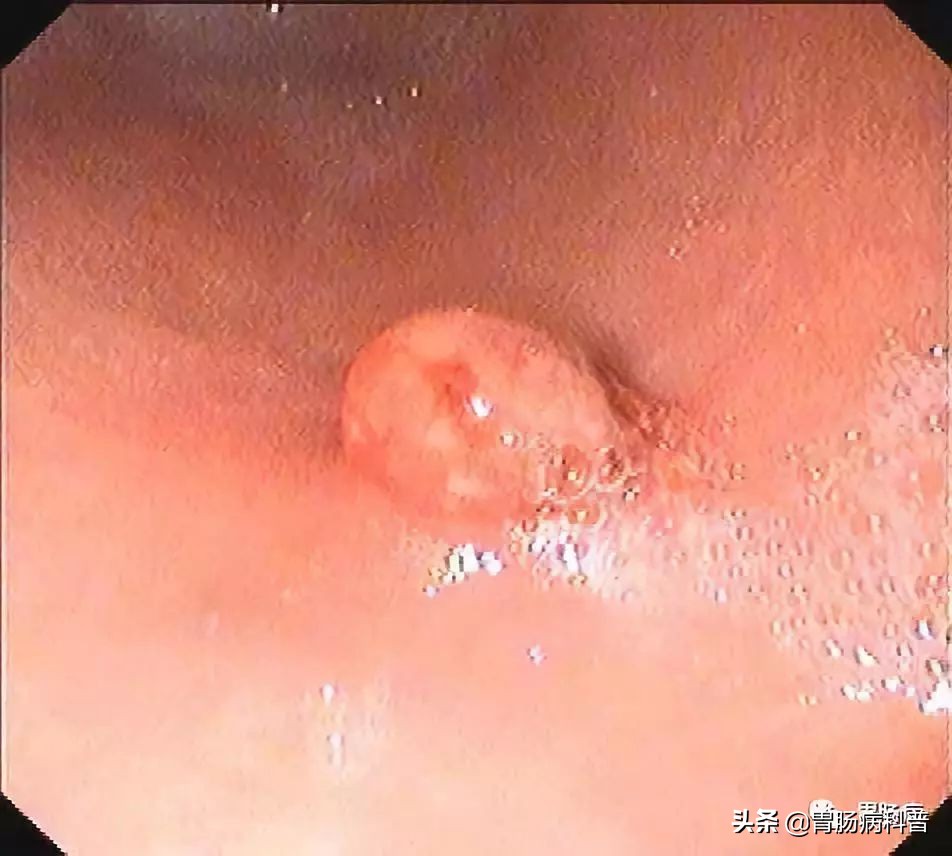 长了胃息肉怎么治疗好,长了胃息肉会有什么症状