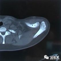 肩锁关节脱位手术后多久可以喝酒,肩锁关节脱位钢板内固定步骤记录