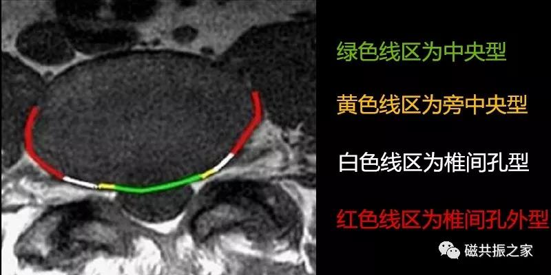 腰椎有哪些病变,腰椎病变有几种
