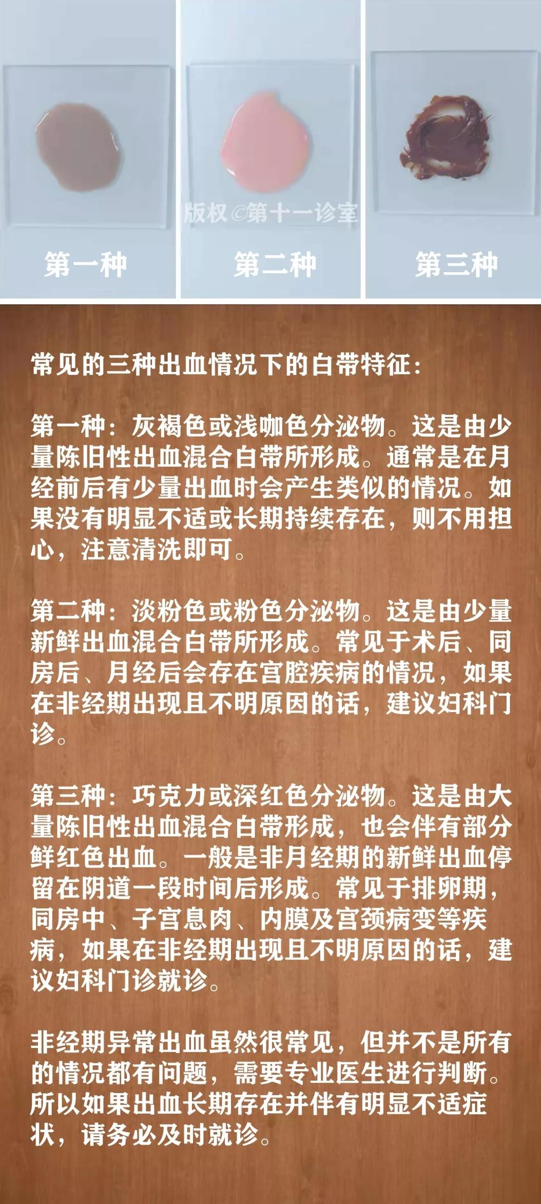 姑娘,关于白带的这些知识,你必须知道