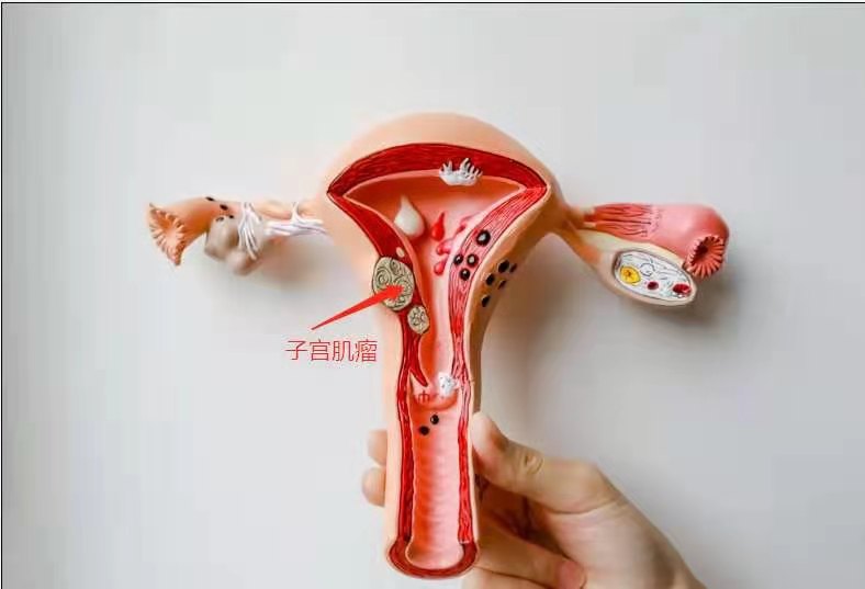 子宫肌瘤变性3公分要做手术吗,子宫肌瘤8公分不做手术有危险吗