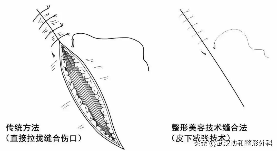手术后怎么预防疤痕用什么药膏,预防疤痕增生最佳方法