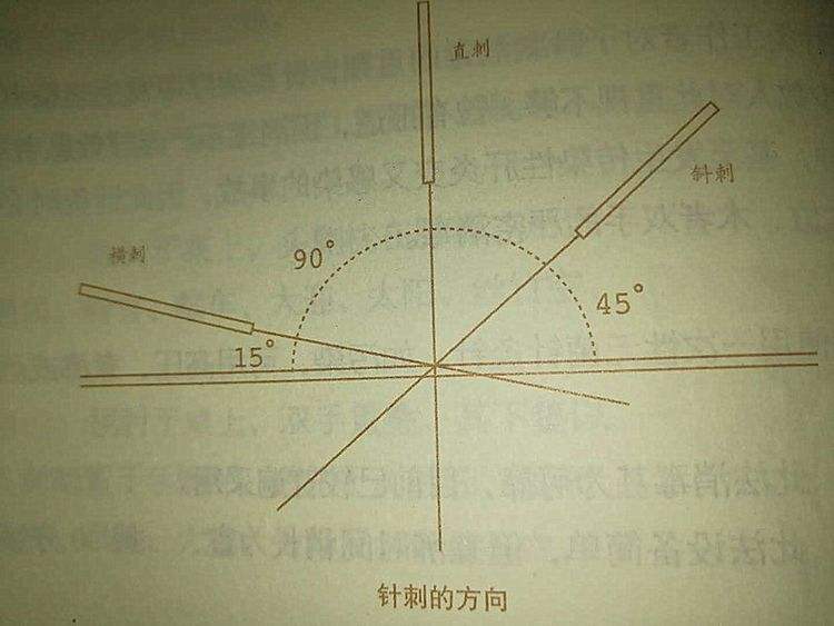 风池穴疼痛针灸什么穴位,风池穴疼痛艾灸哪个穴位