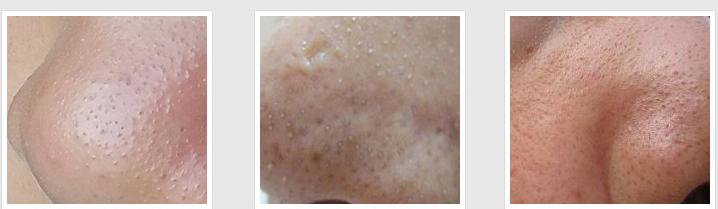 黑头毛孔粗大亲身经历改善,脸蛋上有黑头毛孔粗大怎么办